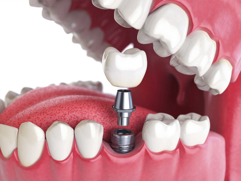 implantologia dentiera renova