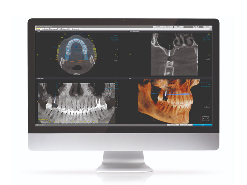 tac cone beam 3d scansione dentista emilia